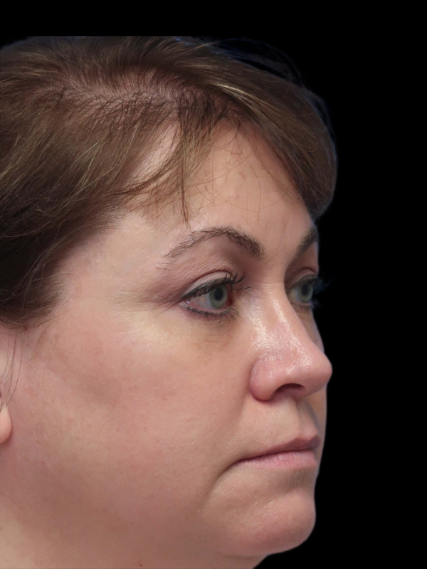 Blepharoplasty Before & After