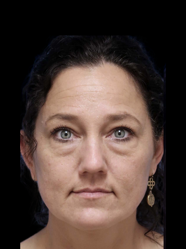 Blepharoplasty Before & After