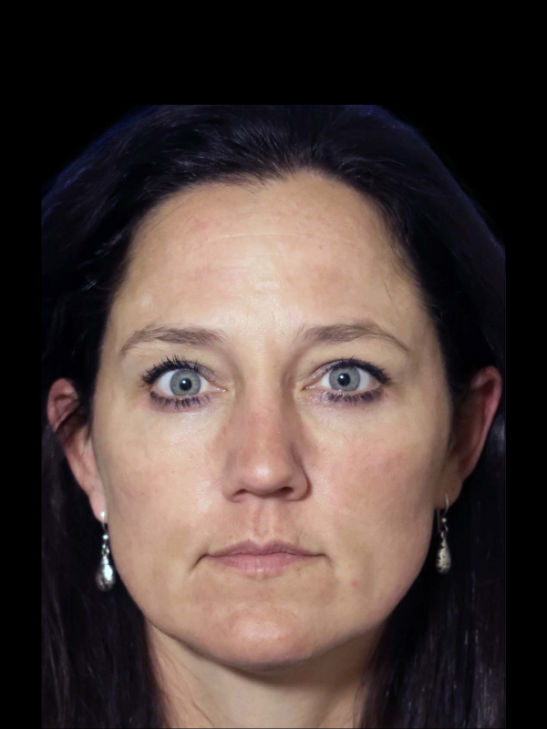 Blepharoplasty Before & After