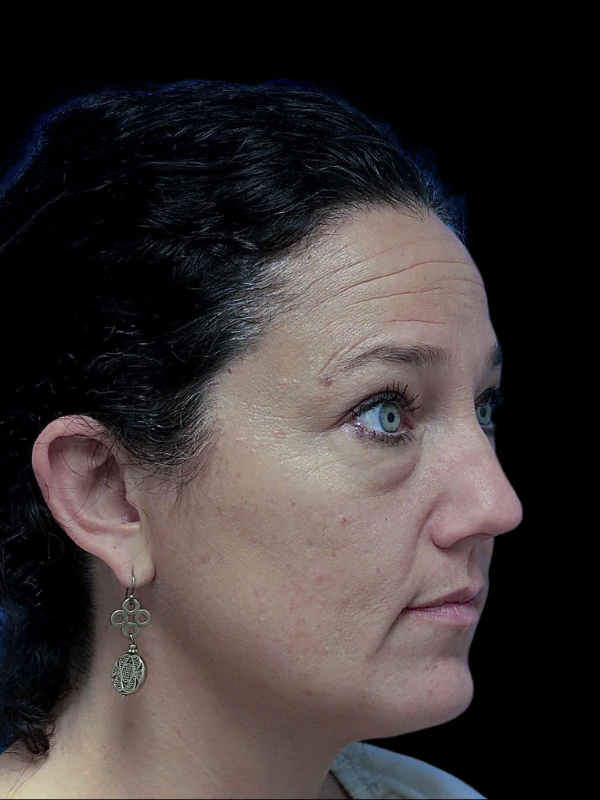 Blepharoplasty Before & After