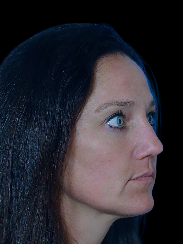 Blepharoplasty Before & After