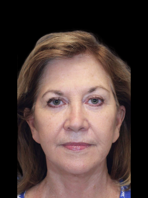 Blepharoplasty Before & After