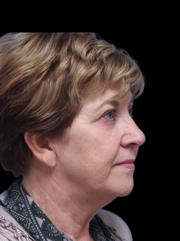 Blepharoplasty Before & After