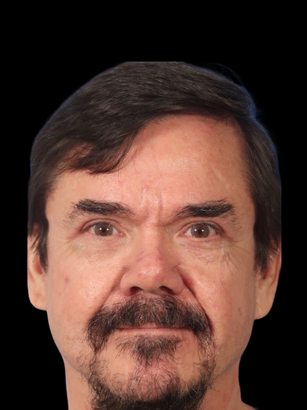 Blepharoplasty Before & After