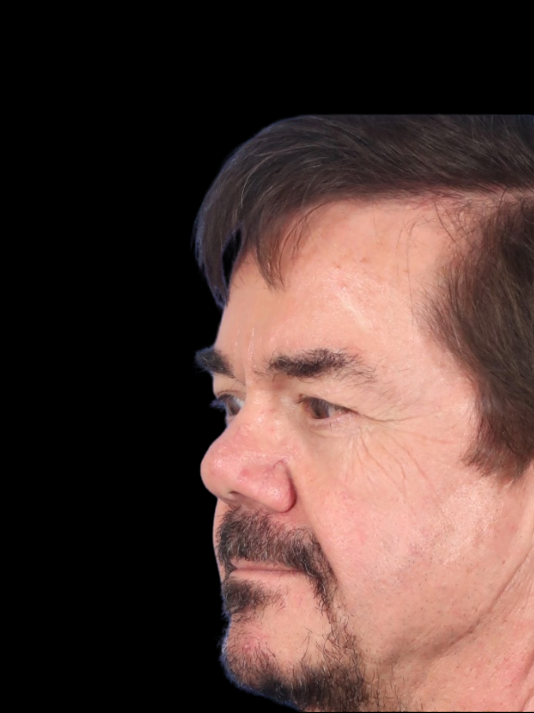 Blepharoplasty Before & After