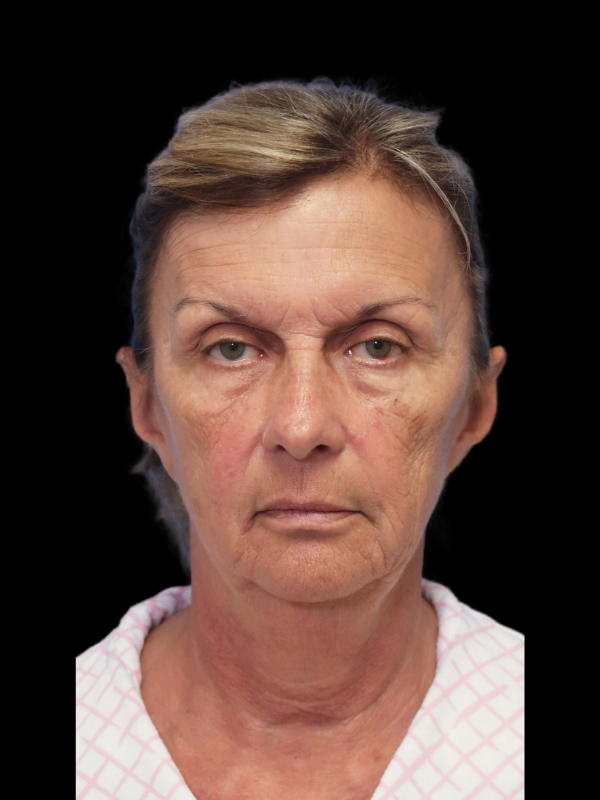 Blepharoplasty Before & After