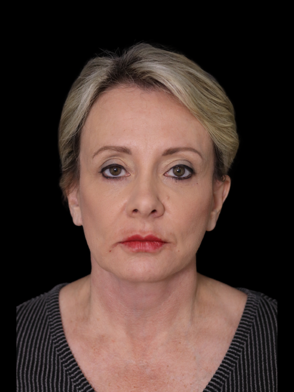 Blepharoplasty Before & After