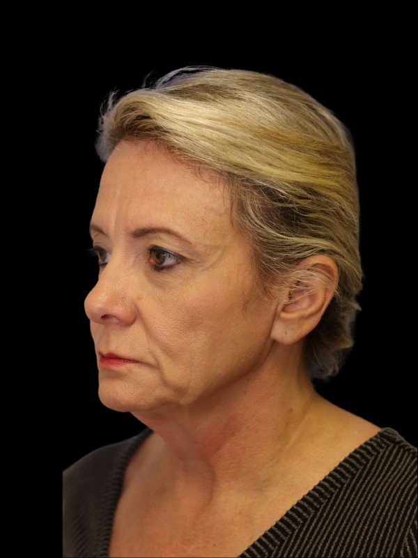 Blepharoplasty Before & After