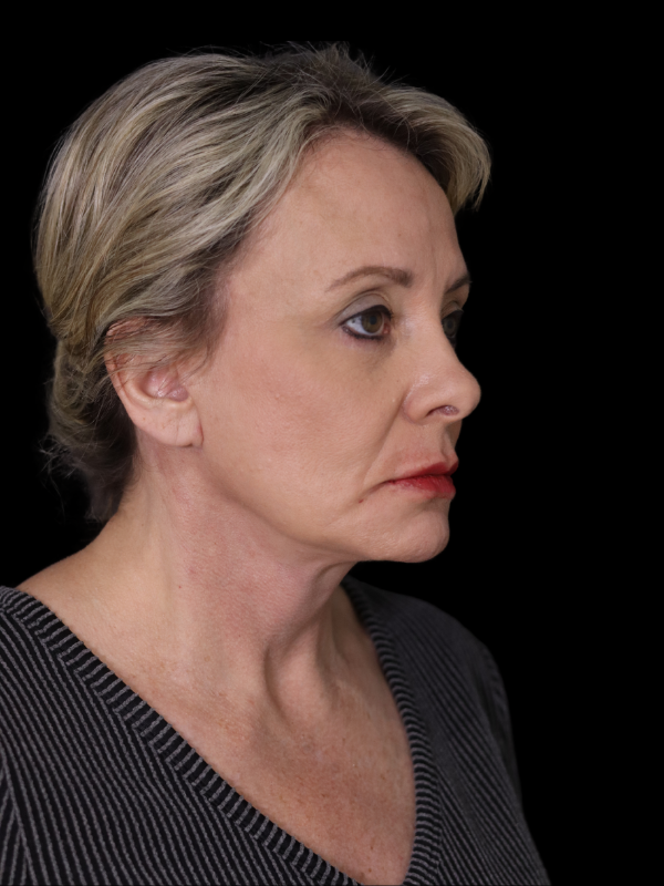 Blepharoplasty Before & After