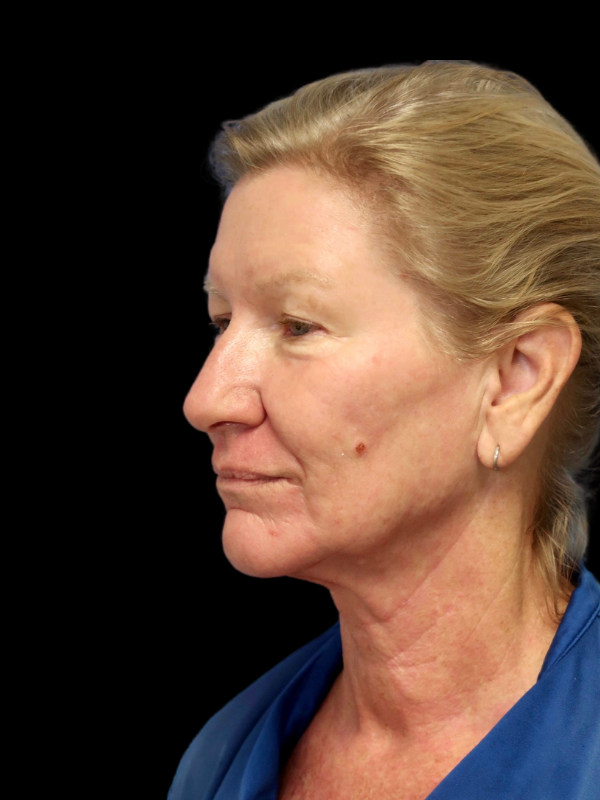 Blepharoplasty Before & After