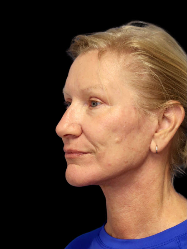 Blepharoplasty Before & After