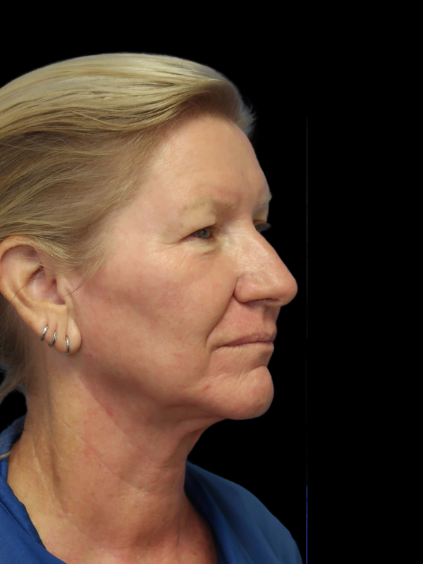 Blepharoplasty Before & After