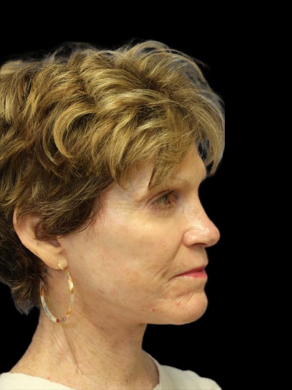 Blepharoplasty Before & After