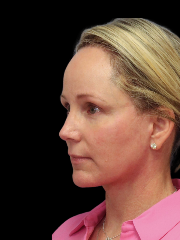 Blepharoplasty Before & After