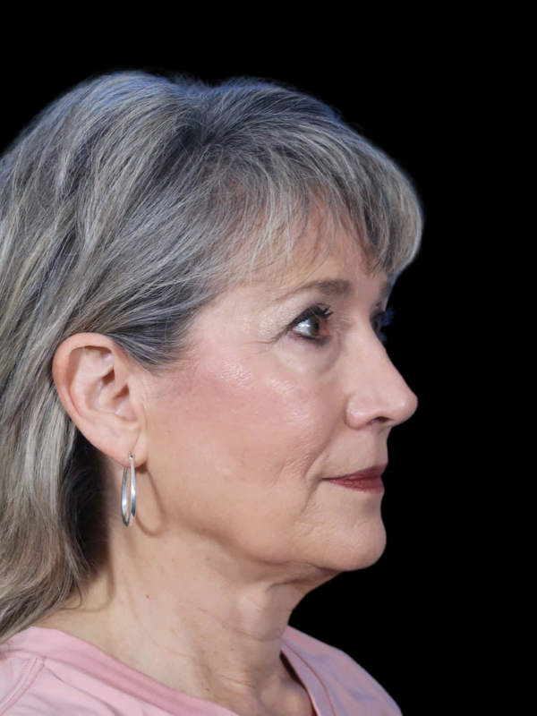 Blepharoplasty Before & After