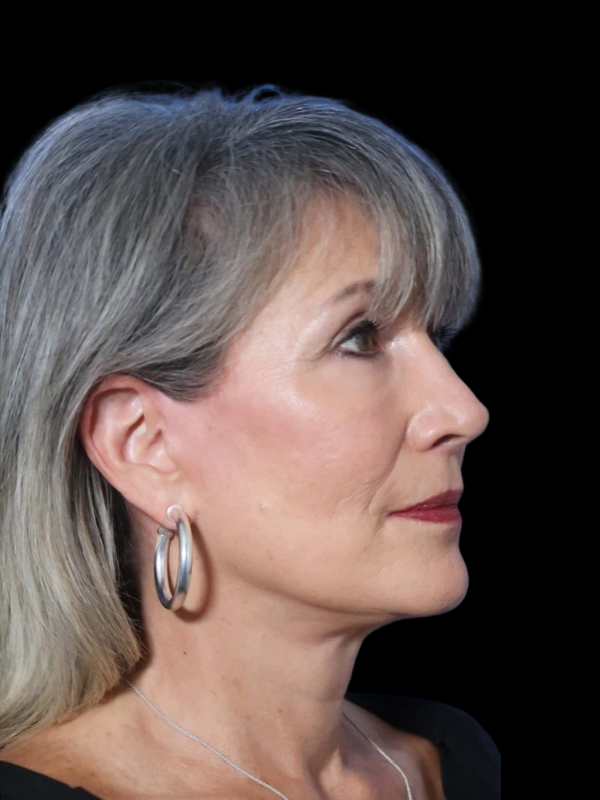 Blepharoplasty Before & After