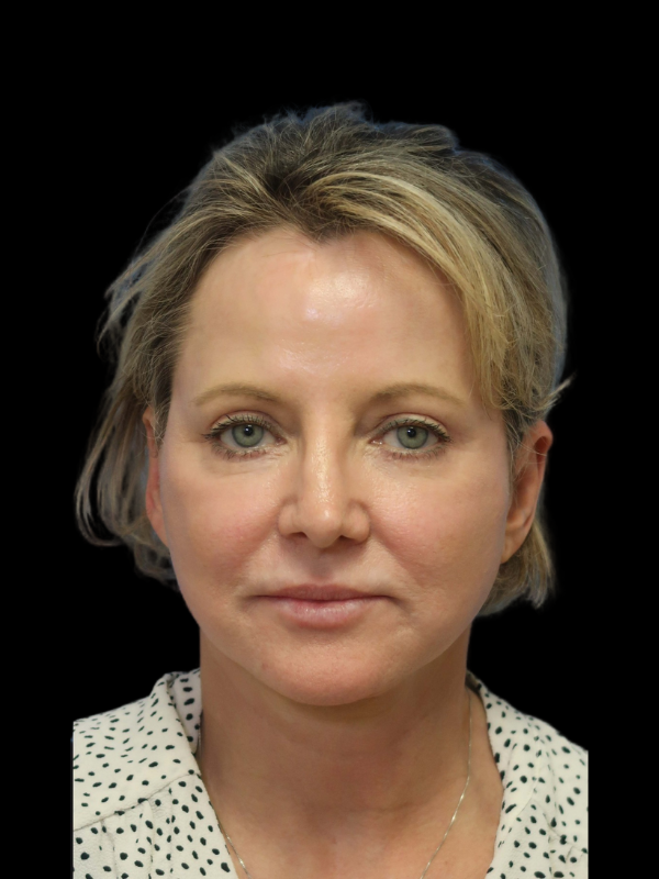 Blepharoplasty Before & After