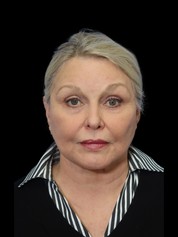 Blepharoplasty Before & After