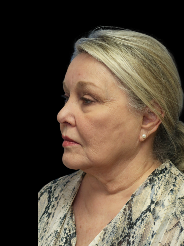 Blepharoplasty Before & After