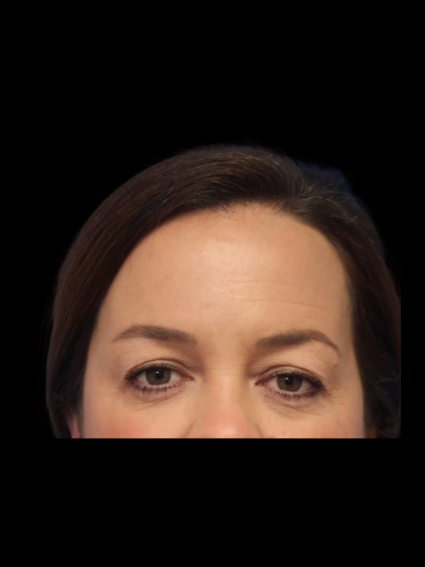 Blepharoplasty Before & After