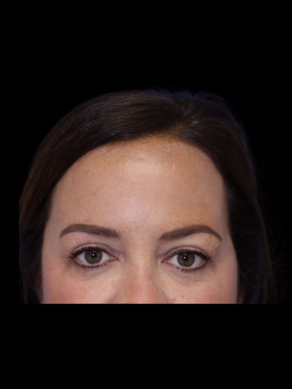 Blepharoplasty Before & After