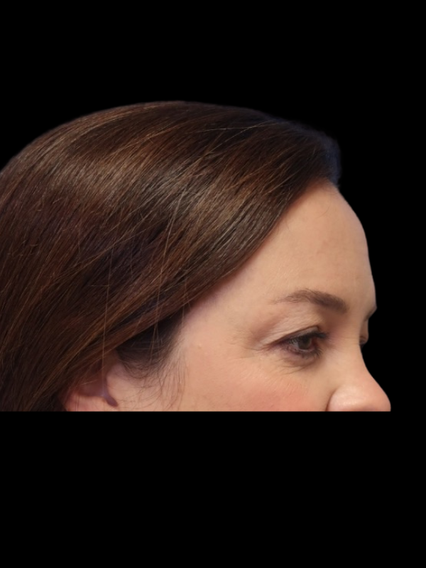 Blepharoplasty Before & After