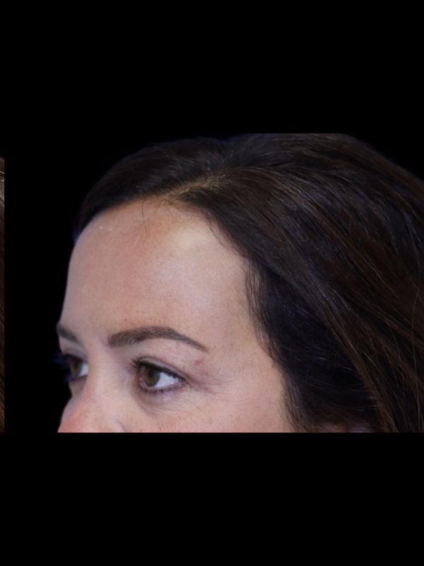 Blepharoplasty Before & After