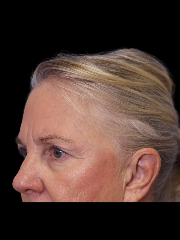 Blepharoplasty Before & After