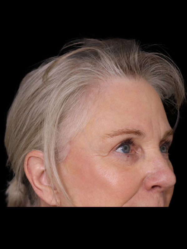 Blepharoplasty Before & After
