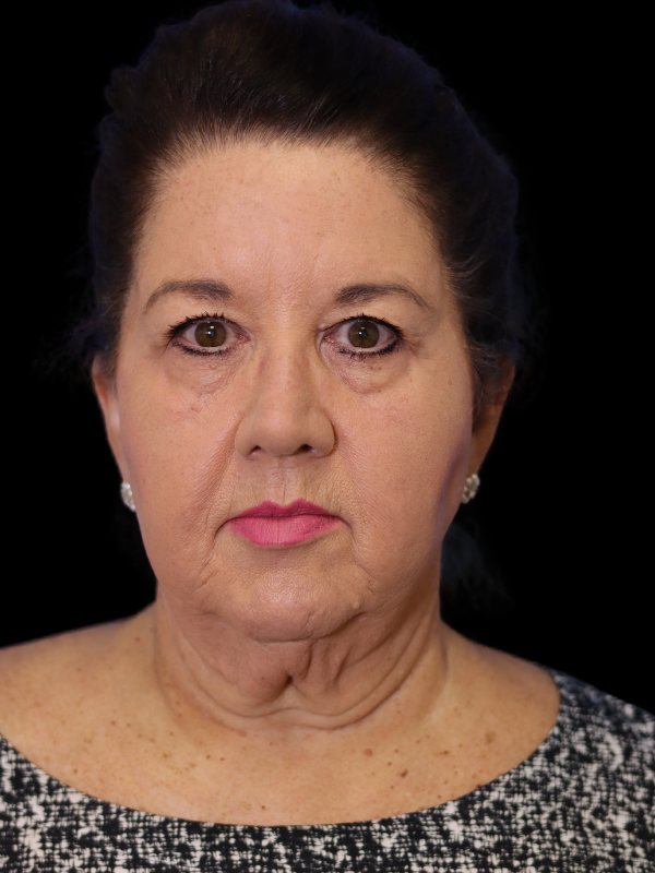 Blepharoplasty Before & After