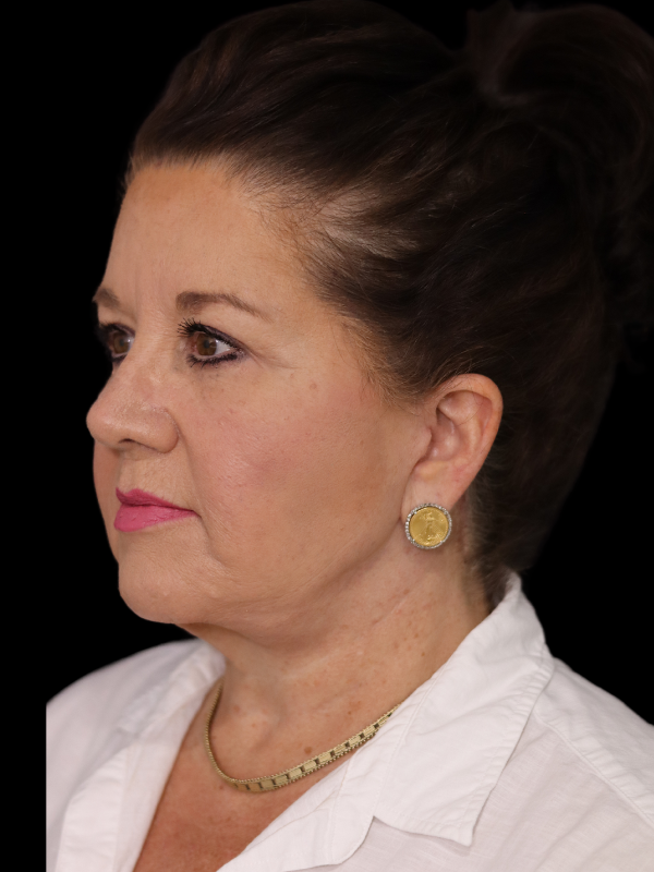 Blepharoplasty Before & After