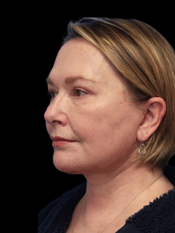 Blepharoplasty Before & After