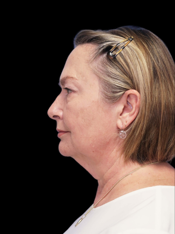 Blepharoplasty Before & After