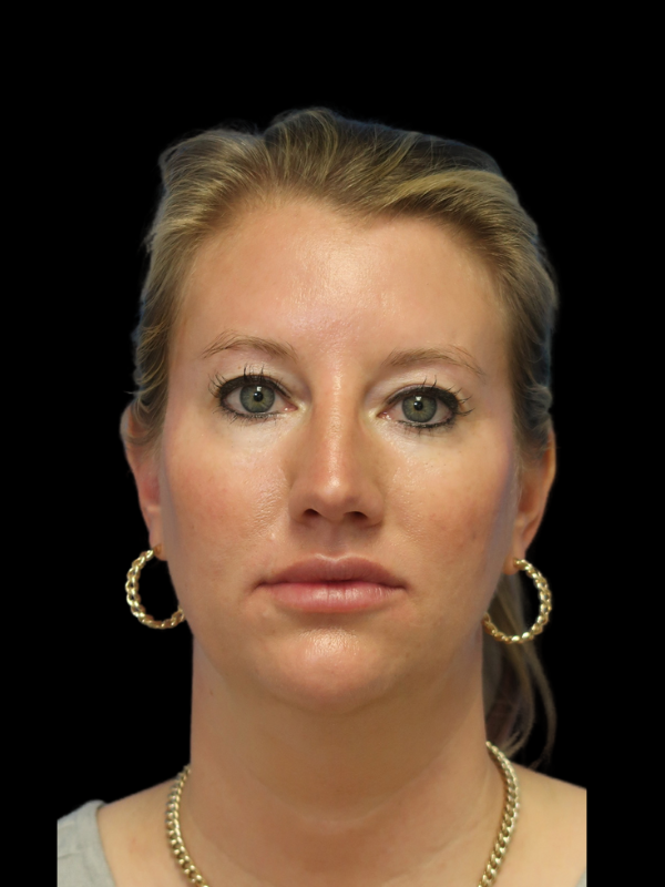 Blepharoplasty Before & After