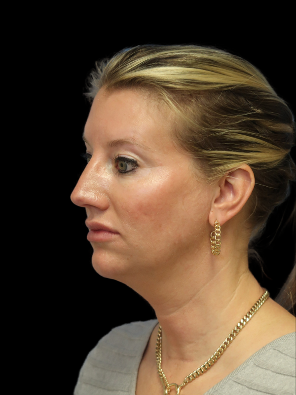 Blepharoplasty Before & After