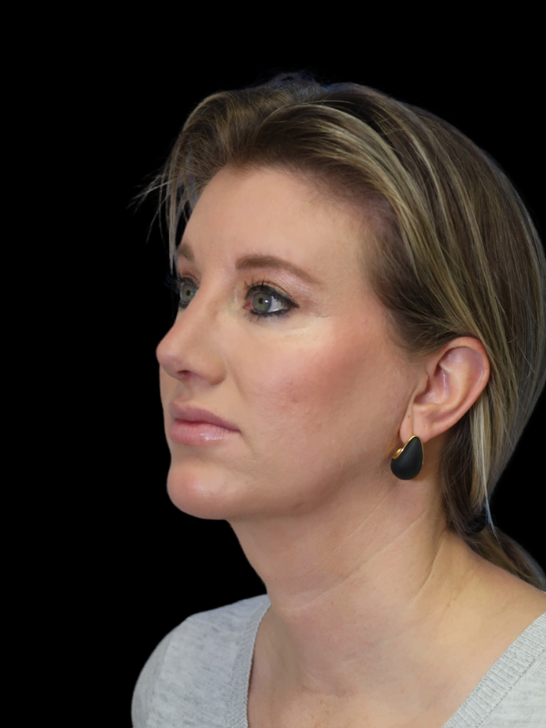 Blepharoplasty Before & After