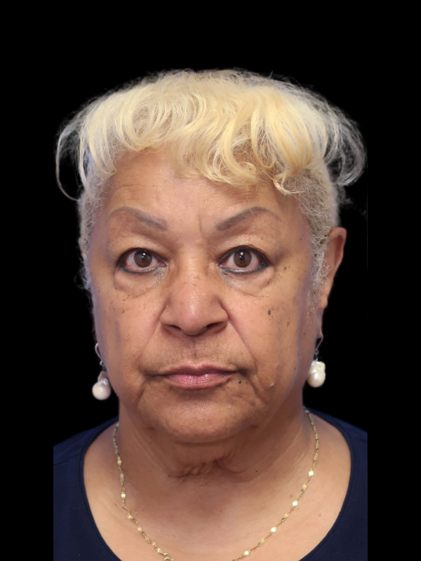 Blepharoplasty Before & After