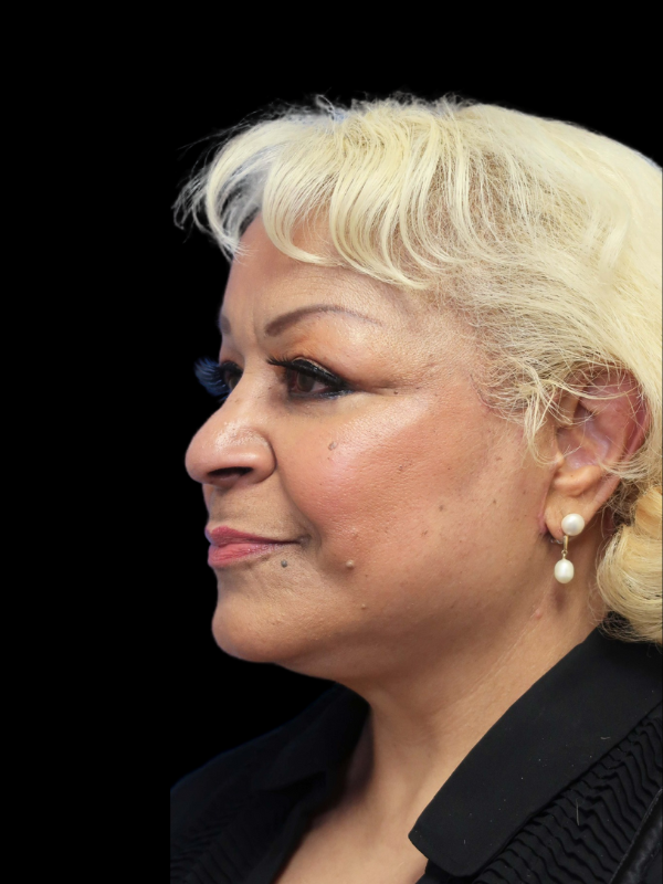 Blepharoplasty Before & After