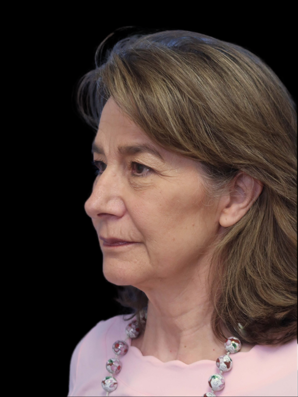 Blepharoplasty Before & After