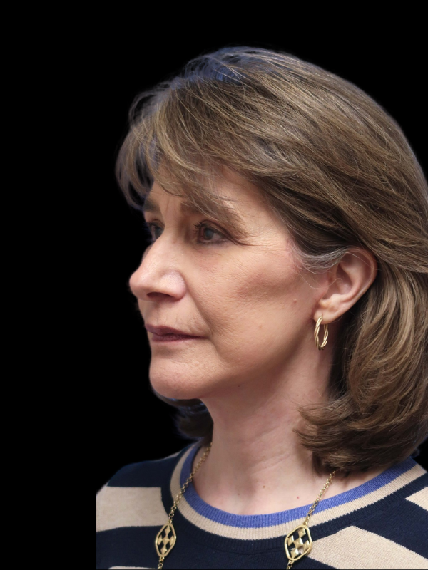 Blepharoplasty Before & After