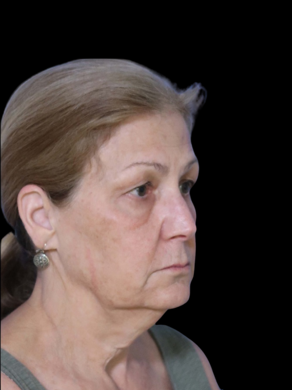 Blepharoplasty Before & After