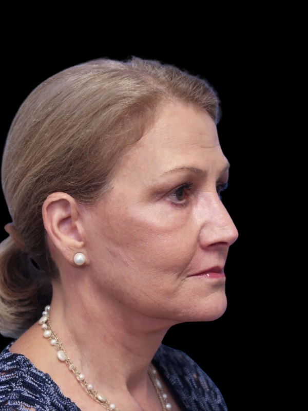 Blepharoplasty Before & After