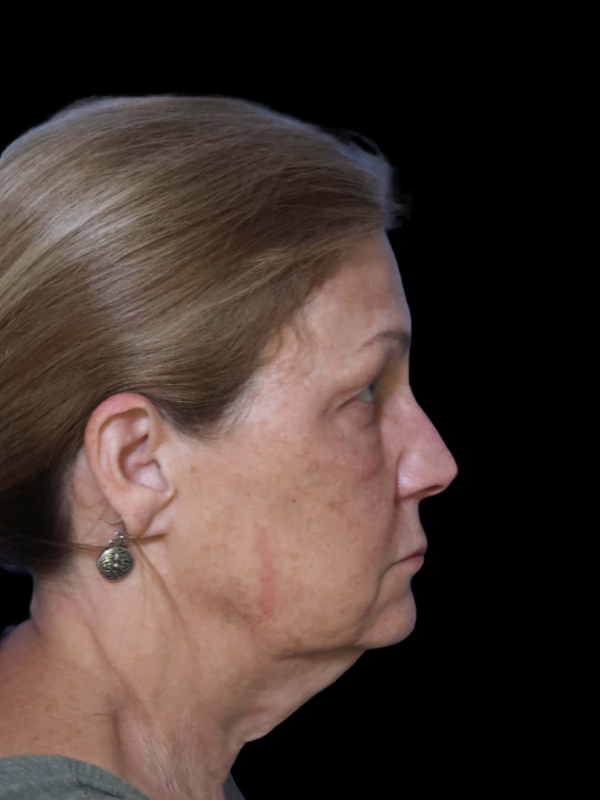 Blepharoplasty Before & After