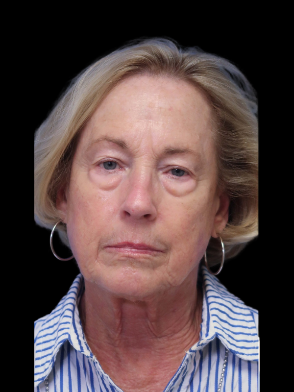 Blepharoplasty Before & After