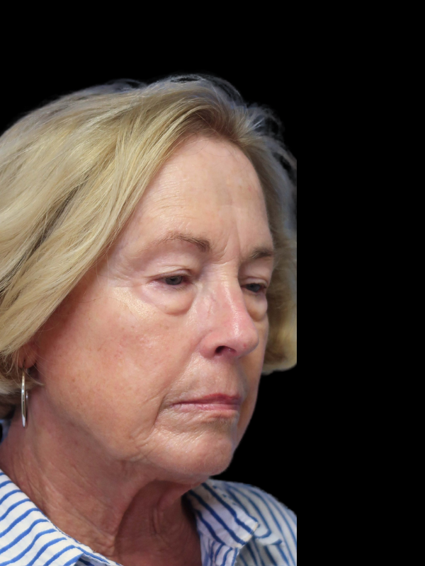 Blepharoplasty Before & After