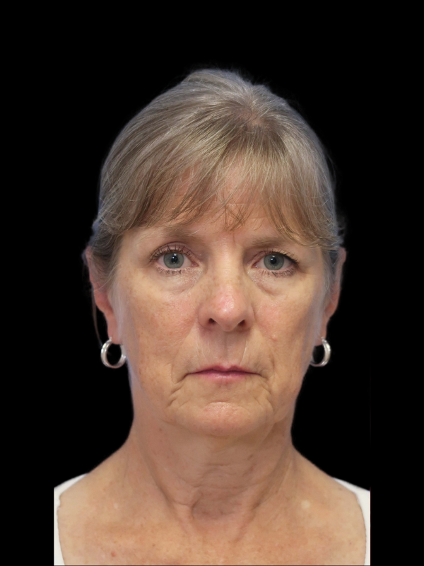 Blepharoplasty Before & After