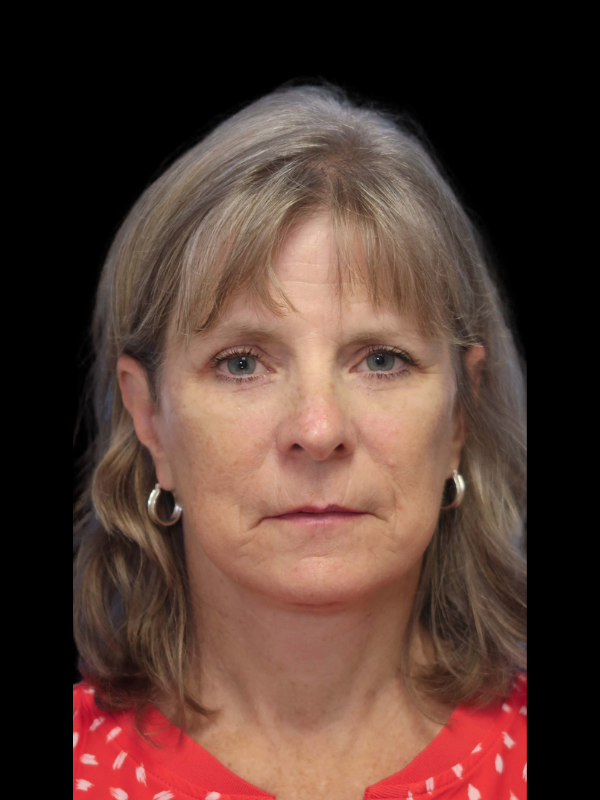 Blepharoplasty Before & After