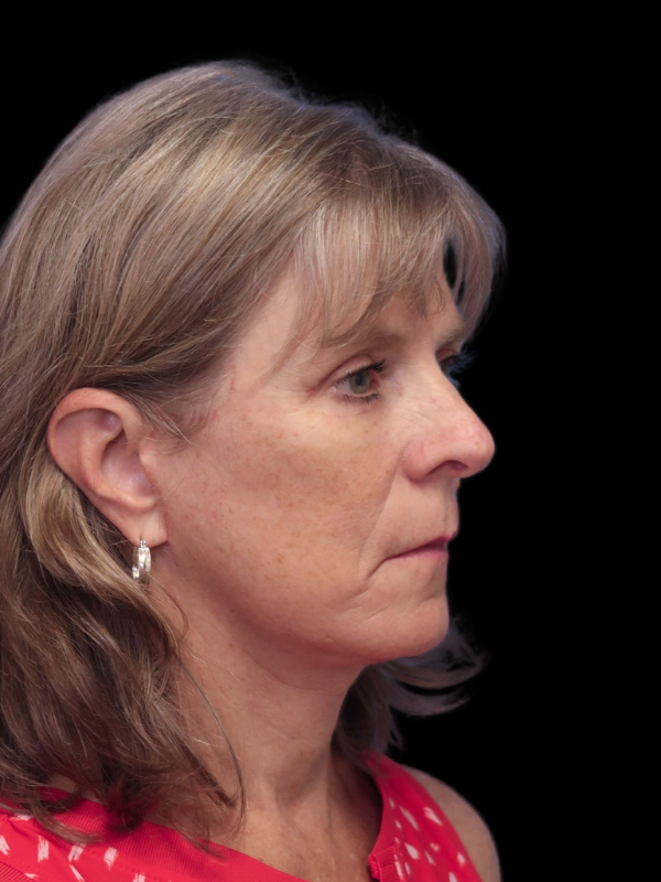 Blepharoplasty Before & After