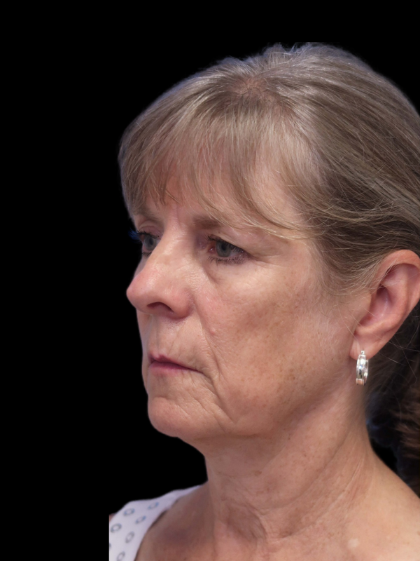 Blepharoplasty Before & After