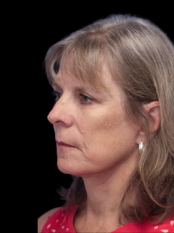 Blepharoplasty Before & After